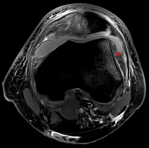 Patella Luxation Axial Patella Luxation Axial